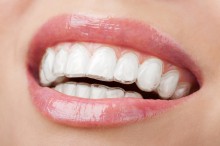 Invisalign láthatatlan fogszabályozás