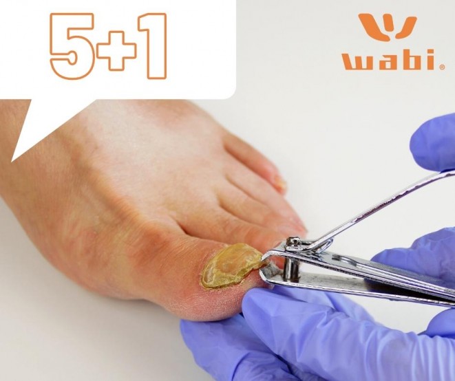 Ints búcsút a körömgombának! MOST 5+1 AKCIÓ a FOTONA lézeres körömgomba-eltávolításra!